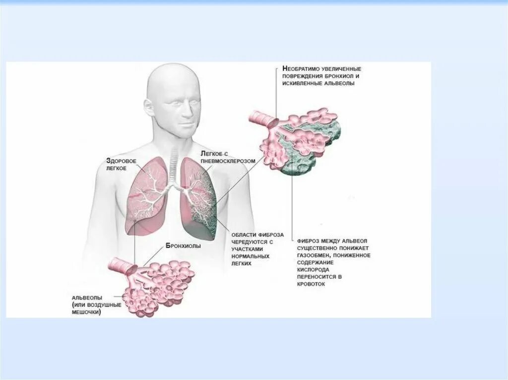 Пневмосклероз это простыми словами. Линейный пневмосклероз s5. Диффузный легочный фиброз. ХОБЛ диффузный пневмосклероз.