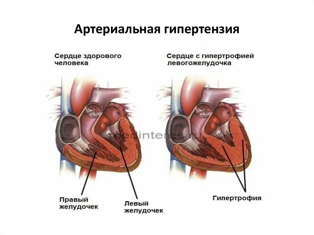 Гипертоническая болезнь сердца. Гипертрофия миокарда левого желудочка при артериальной гипертензии. поражение сердца при гипертонической болезни. гипертрофия миокарда при артериальной гипертонии. артериальная гипертензия изменения в сердце.