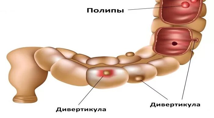 Дивертикулез кишечника сигмовидной кишки. Дивертикулез ободочной и сигмовидной кишки. дивертикул ободочной сигмовидной кишки. дивертикулёз сигмовидной кишечник. дивертикулез дивертикулит толстой кишки.