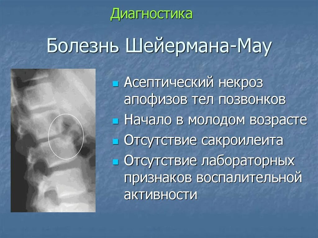 Остеохондропатия апофизов тел позвонков болезнь Шейермана-МАУ. Остеохондропатия позвоночника болезнь Шейермана МАУ. Болезнь Шейермана МАУ грудного отдела позвоночника. Остеохондропатия тел позвонков рентген.