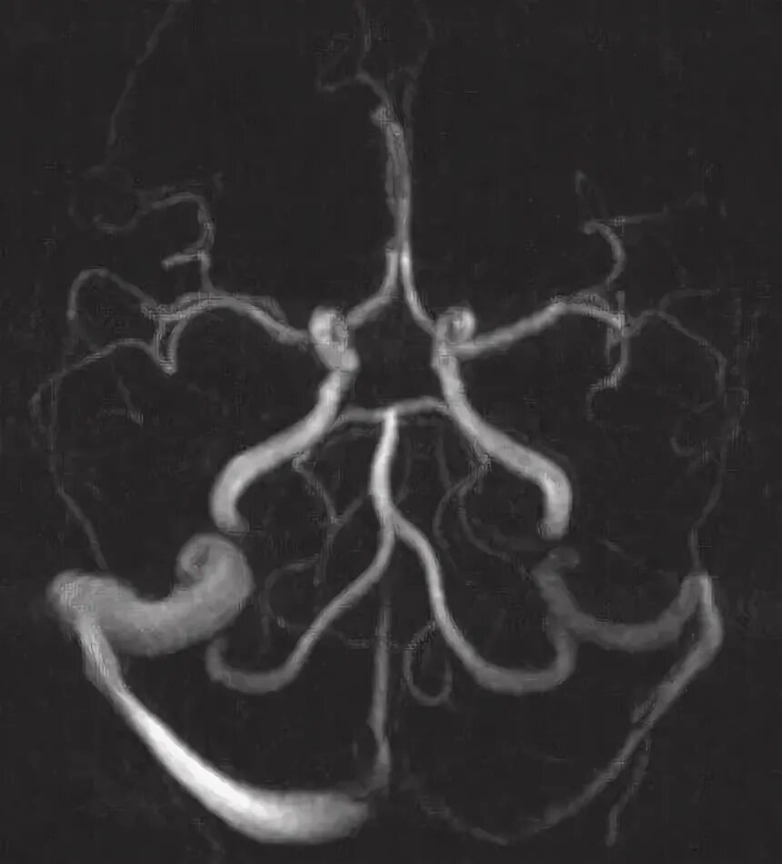 Гипоплазия правой артерии головного мозга. Аплазия поперечного синуса мрт. Гипоплазия левого поперечного синуса. Мрт. Виллизиев круг мрт. Гипоплазия левого сигмовидного синуса.