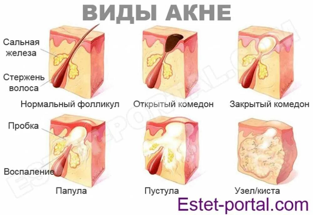 Почему появляются воспаления. Папуло пустулезная форма акне. Узелково-кистозная форма акне. Акне комедон папула пустула. Этапы формирования акне.