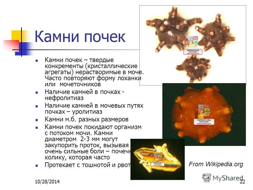 Какая плотность камней в почках. Классификация камней из почек. формирование конкрементов в почках. классификация конкрементов почек.