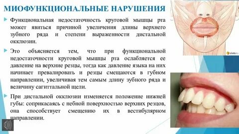 Гипертонус языка это