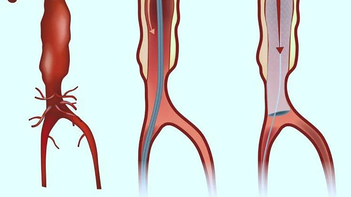 Аневризма стент. Баллонная дилатация аорты. Баллонная дилатация коарктации аорты. Разрыв аневризмы брюшной аорты.
