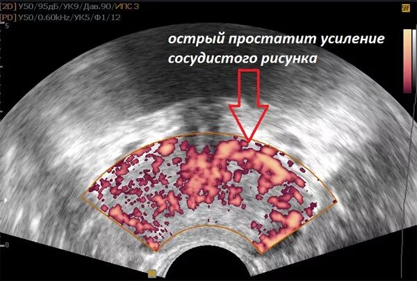 Простата форма. Острый и хронический простатит. Хронический калькулезный простатит УЗИ.