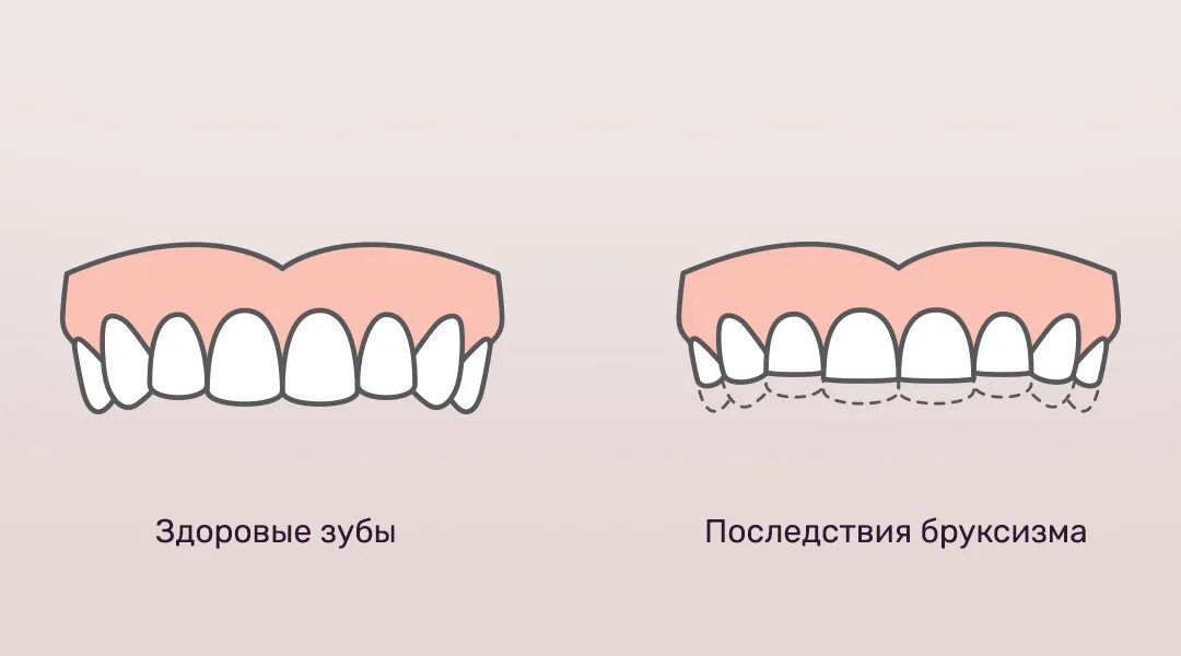 Как лечат бруксизм у взрослых. Бруксизм скрежетание зубами.