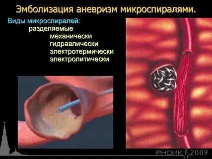 Реабилитация после аневризмы