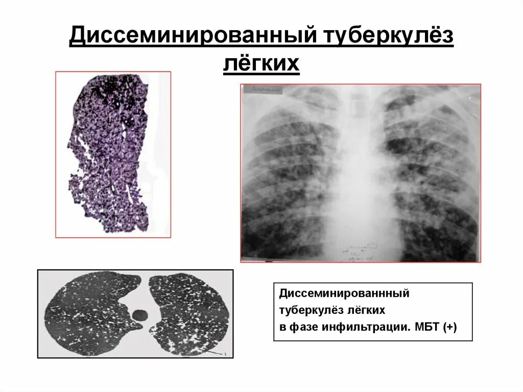 Диссеминированный туберкулез фаза инфильтрации