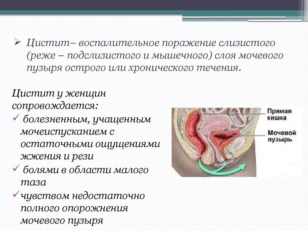 Цстти. Воспалительные заболевания мочевого пузыря. Заболевания мочевыделительной системы цистит.