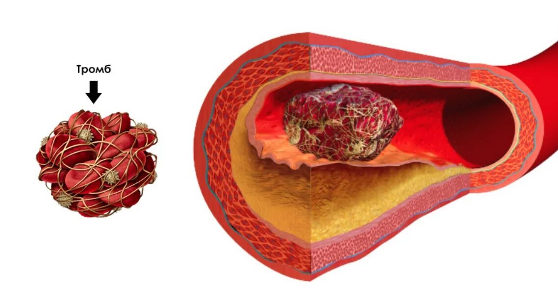 Тромбоз кровеносных сосудов. Тромбоэмболия кровеносного сосуда. Тромбоз пузырной артерии. Тромб в кровеносном сосуде. Сосудистые тромбы