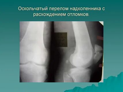 Перелом надколенника