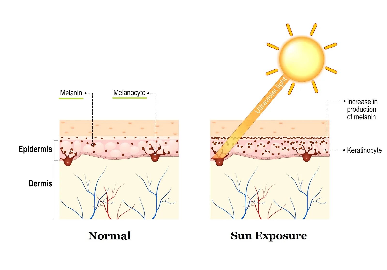Пигмент кожи меланин находится. Меланин схема кожи. Меланоциты меланин кожа. Клетки меланина в коже. Кожа под воздействием солнечных лучей.
