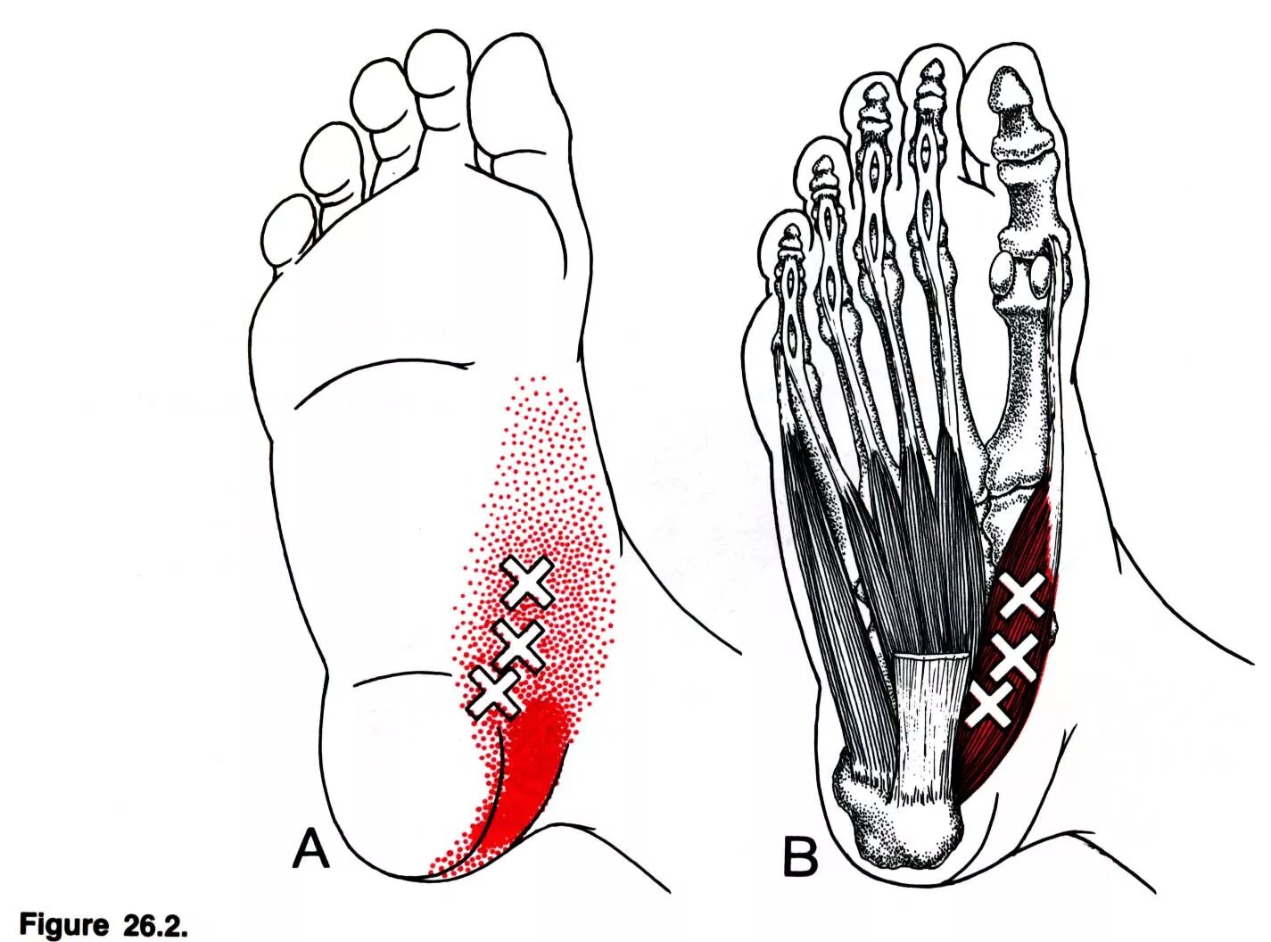 Болит ступня большой палец. Триггерные точки мышц стопы. Abductor Hallucis мышца. Триггерные точки голеностопного сустава. Триггерные точки боль в стопе.