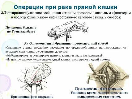 Операция на кишечнике отзывы