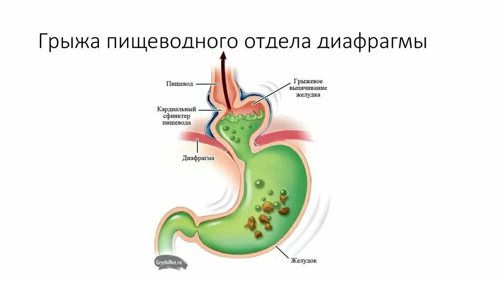 ГЭРБ грыжа пищеводного отверстия диафрагмы. Грыжа мембраны желудка. Грыжа пищевого отдела диафрагмы. Грыжа пищеводного отверстия диафрагмы мкб. Грыжа пищеводного отверстия причины