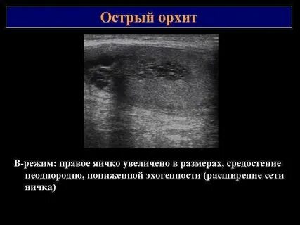 Уменьшение яичек у мужчин