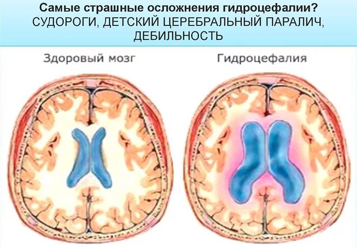 Смешанный гидроцефалия у взрослых. Заместительная наружная гидроцефалия кт. наружная гидроцефалия головного мозга ребенок мрт. гидроцефалия классификация мрт. наружная парциальная гидроцефалия головного.