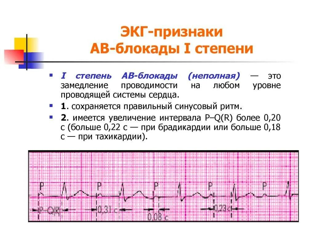 Блокада сердца это опасно. ЭКГ АВ блокада 1. Атриовентрикулярная блокада ЭКГ критерии. ЭКГ критерии АВ блокады 1 степени. ЭКГ при АВ блокаде 1 степени.