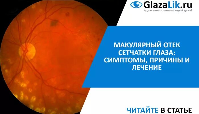 Макула глаза как лечить. Макулярный отёк сетчатки. диабетический макулярный отек окт. макулопатия макулярный отек. сетчатка глаза отек лекарство.