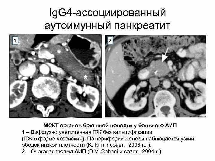 Диффузные изменения брюшной полости. Эхинококкоз поджелудочной железы кт. кт брюшной полости панкреатит. заболевания ассоциированные с igg.