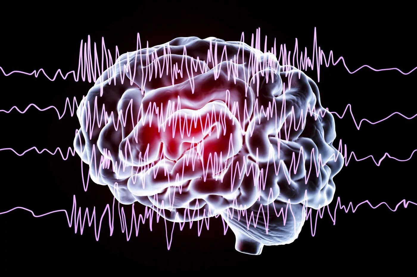 Эпилепсия мозг. Тема эпилепсия