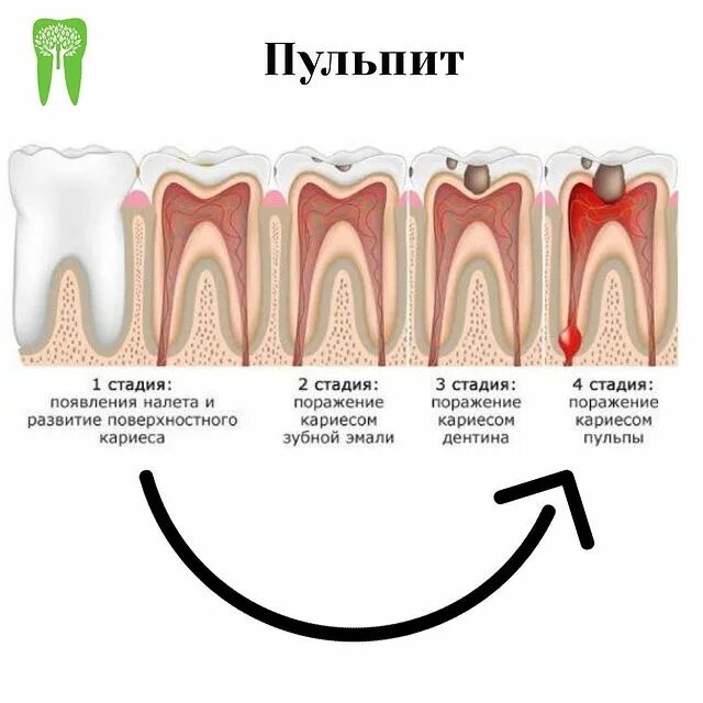 Классификация пульпитов молочных зубов. Строение зуба кариес пульпит. Острый очаговый пульпит. Кариес пульпит периодонтит у детей. Пульпит зуба стадии.