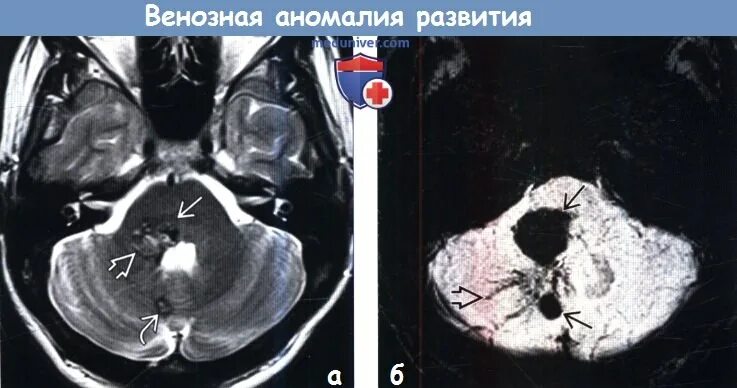 Венозно кавернозная гемангиома. Венозная ангиома мозжечка мрт. Кавернозная ангиома мозжечка. Венозная ангиома у ребенка. Кавернома головного мозга кт.