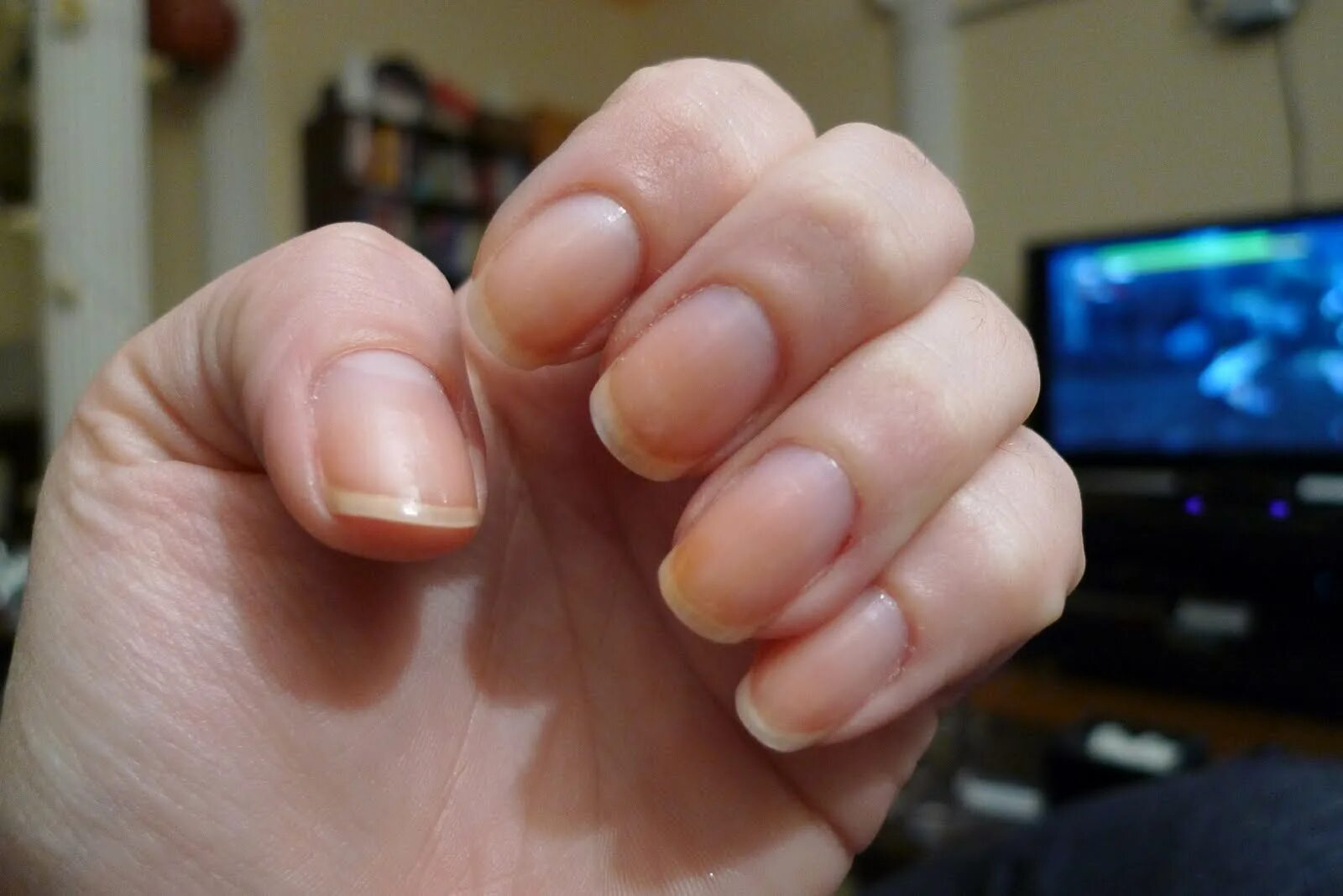 От чего синеют ногти. Синеватые ногти на руках.