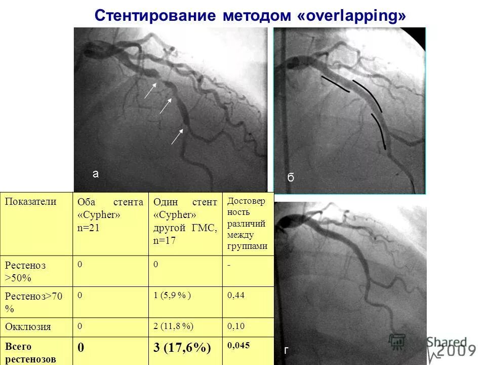 Осложнения коронарного стентирования. Кардиологические стенты серийные номера. Трудоспособность при инфаркте миокарда. После стентирование сосудов сердца дают инвалидность. После стентирование сосудов сердца дают инвалидность.