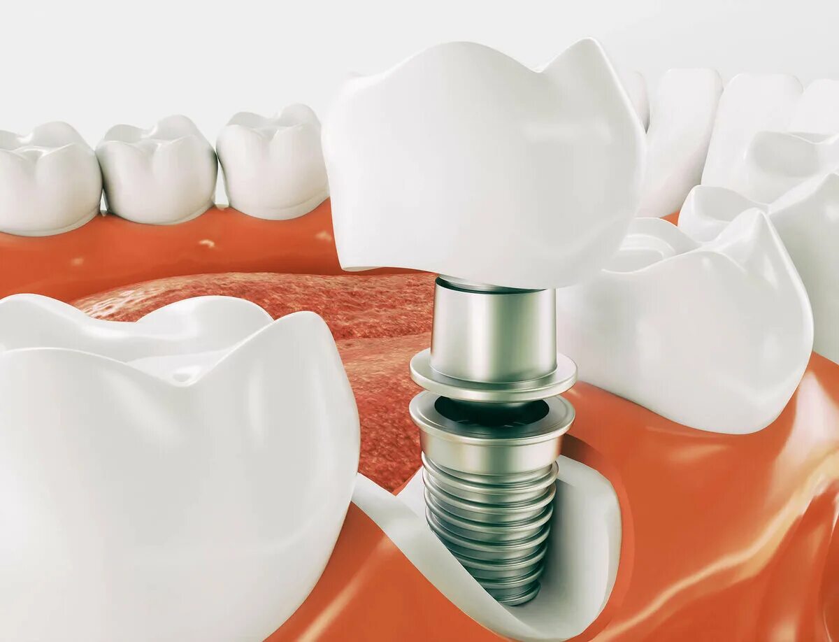 Имплантат Osstem Корея. Двухэтапная имплантация зубов. Одноэтапная имплантация зубов. Одноэтапная методика имплантации.