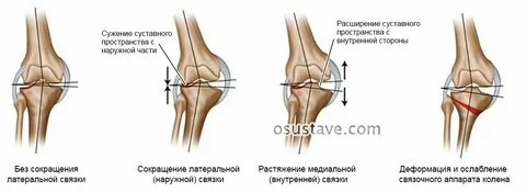 Вальгусная деформация сустава