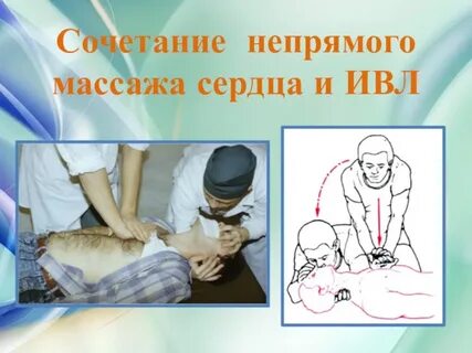 Ивл непрямой массаж