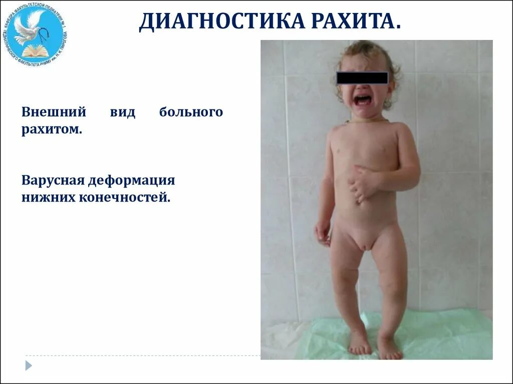 Питание больного рахитом. Хондродистрофия, рахит. фосфоропенический рахит. внешний вид ребенка с рахитом. гаррисонова борозда при рахите.