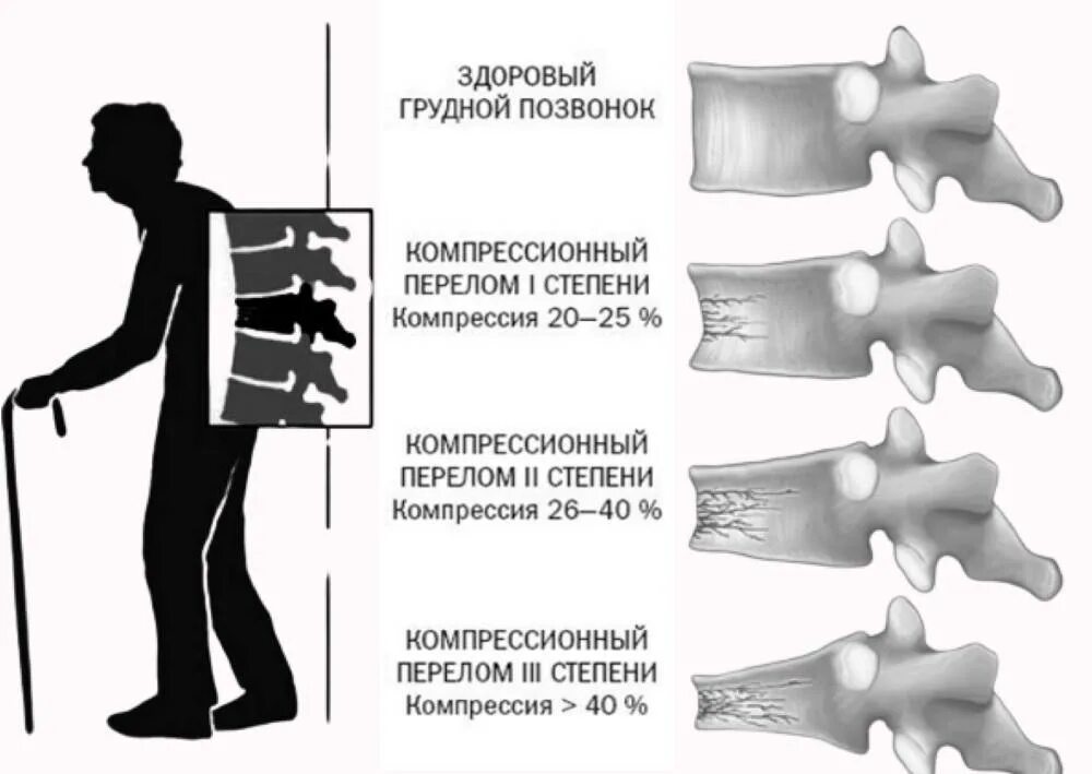 Перелом позвоночника у ребенка последствия. Компрессионный перелом позвоночника l12. Клиновидный компрессионный перелом позвоночника. Компрессионный перелом т12 позвонка. Компрессионный перелом позвоночника т11.