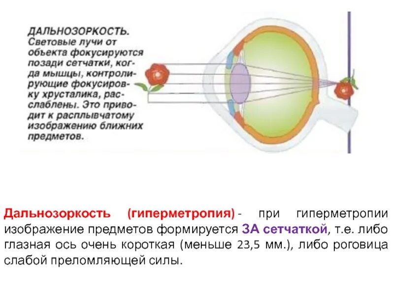 Дальнозоркость это когда. При дальнозоркости световые лучи фокусируются. При дальнозоркости изображение фокусируется. Дальнозоркость лучи света фокусируются. Лучи фокусируются близорукость и дальнозоркость.