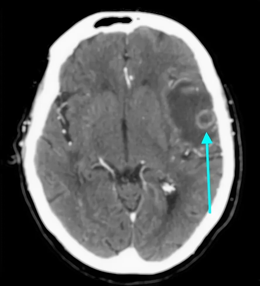 Меланома метастазы в мозг. Метастазы головного мозга кт. Метастаз в головном мозге кт мрт. Метастазы меланомы в головной мозг мрт. Метастазы в головной мозг при меланоме мрт.