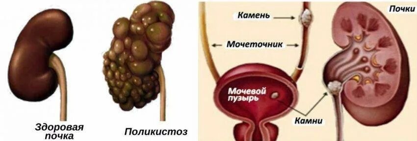 Отказ почек сколько проживет. Поликистоз почки почки.