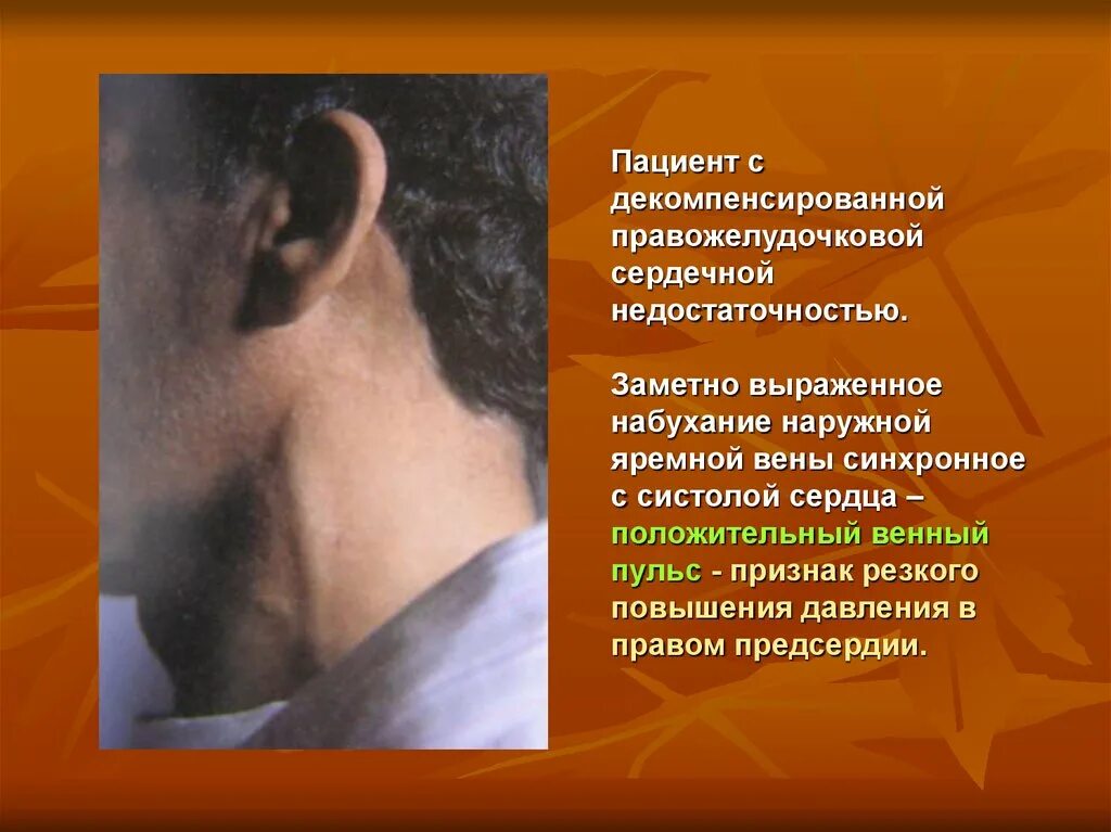 Пульсация каротид