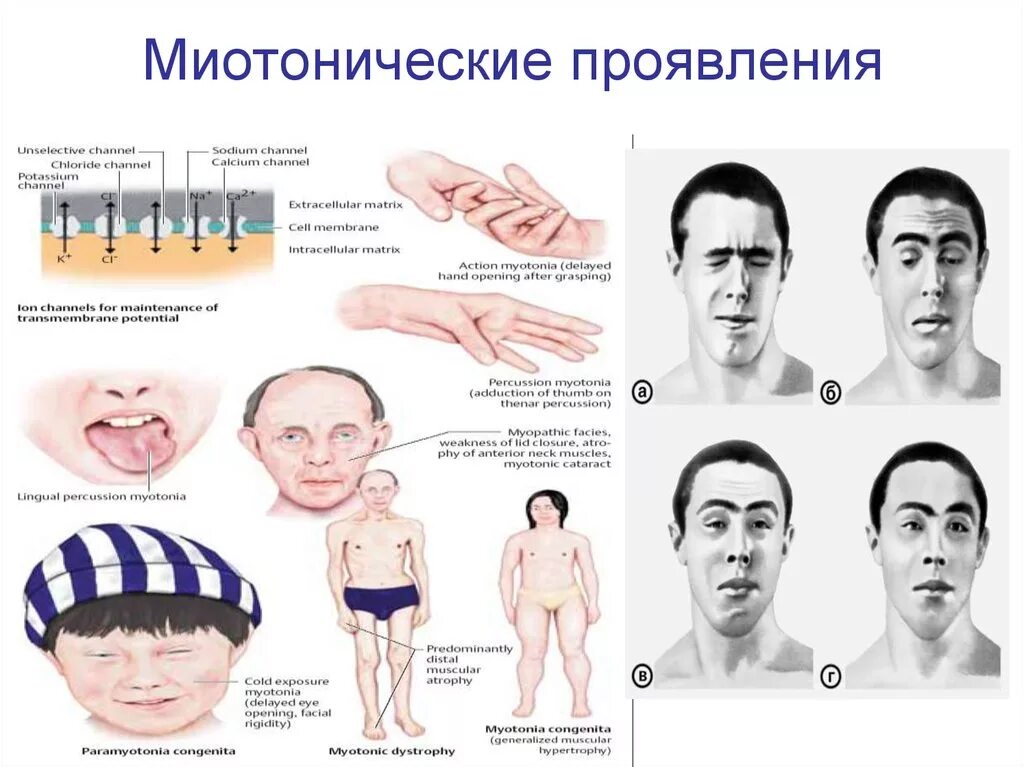 Миотоническая дистрофия синдромы. Миотония это