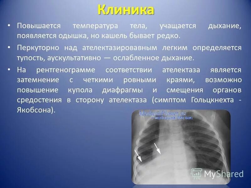 Ателектаз легкого клиника. Ателектаз на рентгенограмме. Ателектаз легкого инородное тело. Компрессионный ателектаз легкого