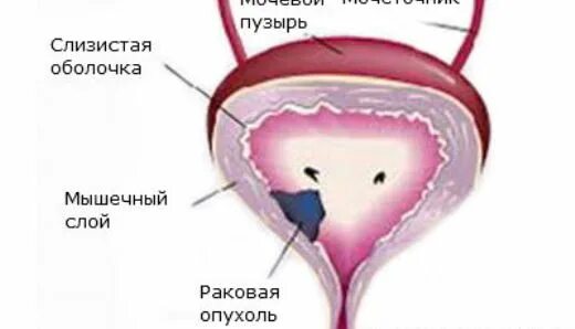 Мочевой пузырь при цистите. Опухоль мочевого пузыря у женщин. Болит мочевой канал. Цистит мочевого пузыря у женщин. Болит мочевой канал.
