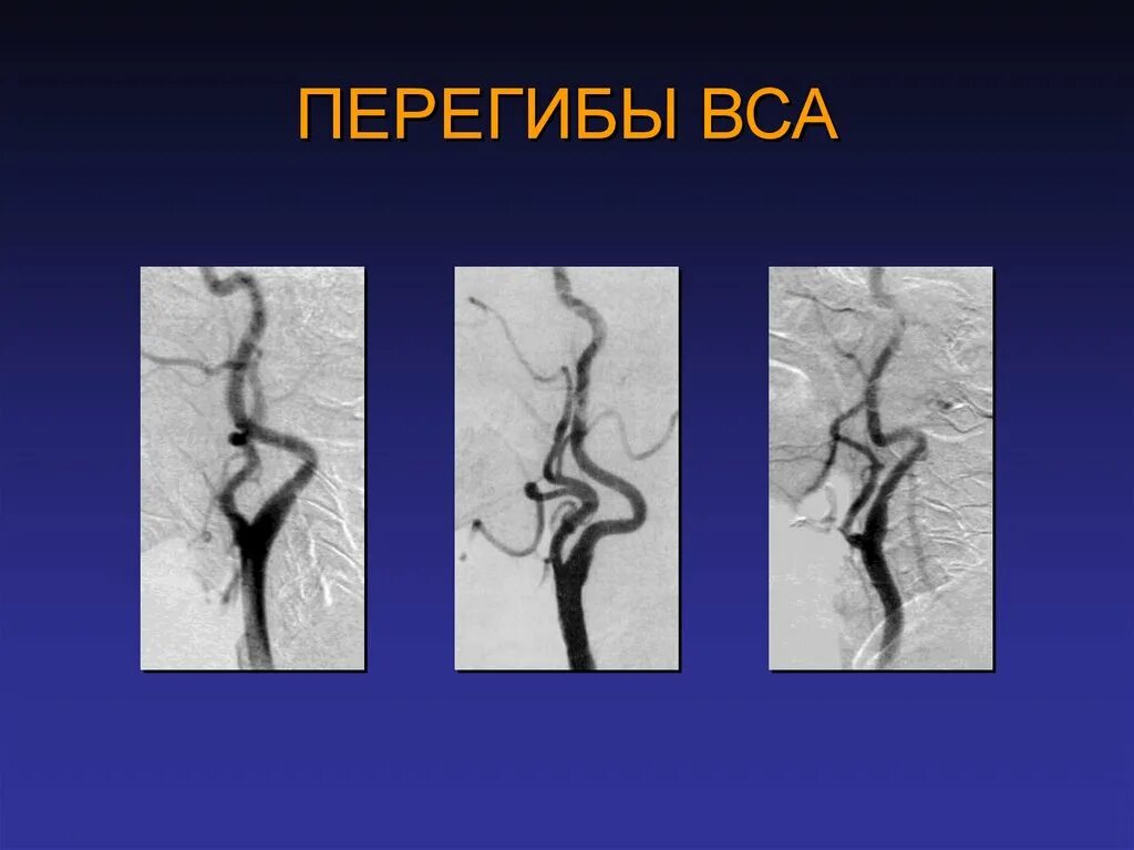 Стеноз устья вса. Извитость внутренней сонной артерии. S-образная извитость внутренней сонной артерии. Патологическая извитость внутренней сонной артерии. Изгибы внутренней сонной артерии.