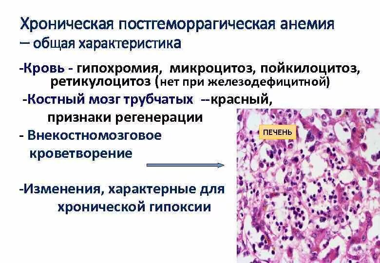 Постгеморрагическая анемия картина крови. Костный мозг при хронической постгеморрагической анемии. Картина крови при хронической постгеморрагической анемии. Хронический миелолейкоз гистология.