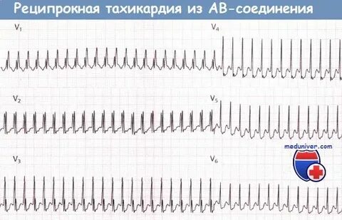 Реципрокная тахикардия
