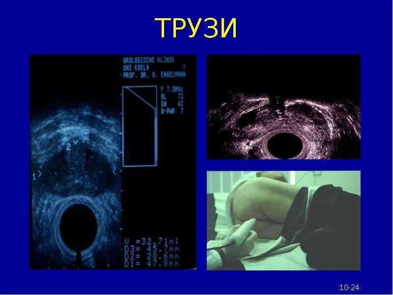 Узи простаты ректально. Трансректальное УЗИ простаты. Трансректальное УЗИ (трузи). Аппарат трузи. Трансректальное исследование предстательной железы.