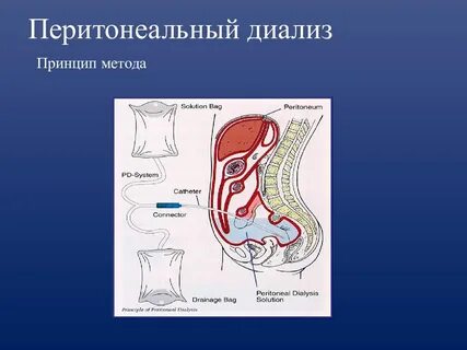 Проведение перитонеального диализа
