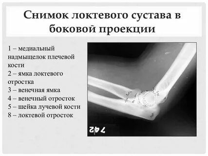 Локтевой сустав анатомия рентген