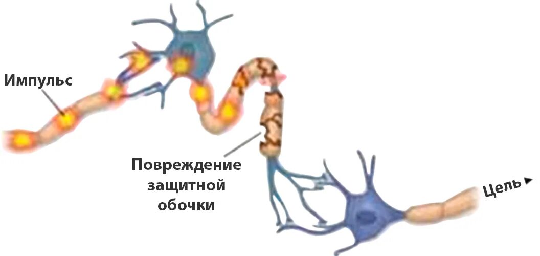 Аксональное демиелинизирующее поражение нерва. Повреждение миелиновой оболочки болезнь. Рассеянный склероз миелиновая оболочка. Аксоны миелиновая оболочка. Разрушение миелиновой оболочки нервных волокон.