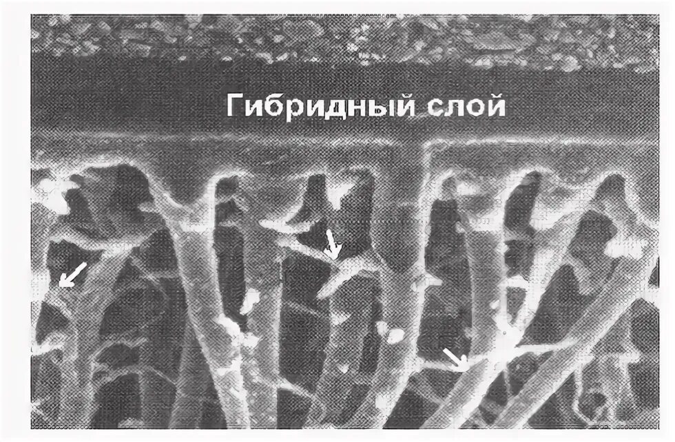 Формирование гибридной зоны. Гибридная зона. Гибридная зона. Гибридная зона. Гибридный слой в стоматологии.